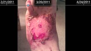 3rd Degree burns on foot - healing time lapse - 2 months