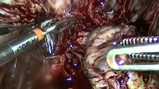 Laparoscopic Management of Severe Endometriosis