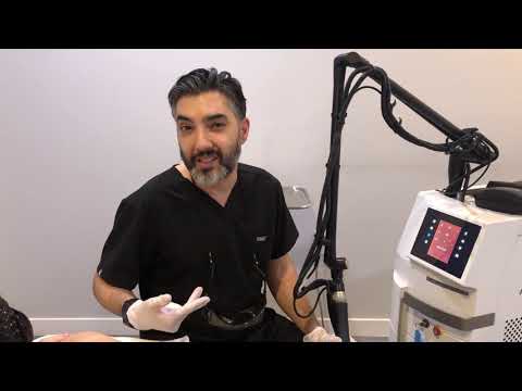 Keloid Scar Removal with NanoRay Laser Resurfacing - Los Angeles