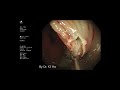 大腸鏡(colonoscopy) 大腸瘜肉切除術-#  Dr Ho Kai Tin # 何佳鈿醫生