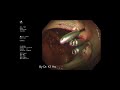 大腸鏡(colonoscopy) 大腸瘜肉切除術-#  Dr Ho Kai Tin # 何佳鈿醫生