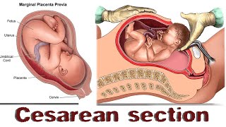 C-SECTION (Cesarean Delivery) | CESAREAN SECTION DELIVERY