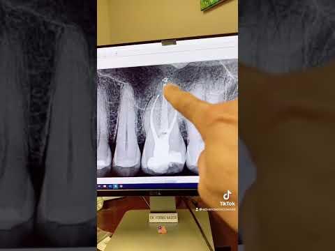 Root canal therapy of a calcified tooth #14.