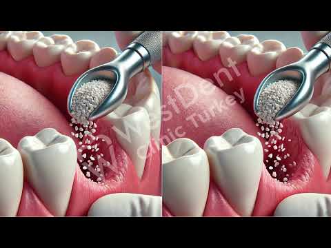 Logo of Key Insights into the Dental Bone Grafting Procedure in Izmir, Turkey