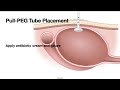 HCC 1475 37 PEG