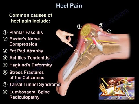 Heel Pain, causes and treatment, plantar fasciitis diagnosis and treatment.