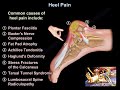 Heel Pain, causes and treatment, plantar fasciitis diagnosis and treatment.