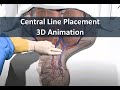 Learn about Central Line Placement with 3D animation