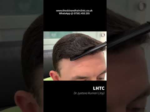 Hair Transplant UK | 6 Months Results | Dr J Kumari | @liverpoolhairtransplantcli3720