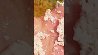 Download lagu Alami Keputihan Lendir Seperti Ini ?? 🥹 mp3