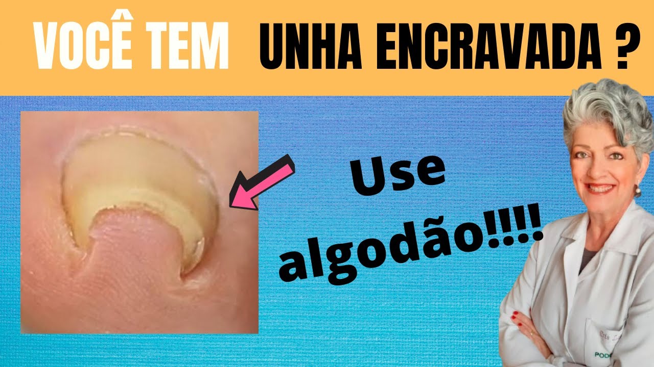Como Cuidar da Unha Encravada Em Casa