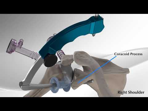 AC Repair Using Dog Bone Button Technology