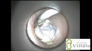 耳掃除動画vol.21「４ヶ月でこんなに…vol.8のお客様再来店」