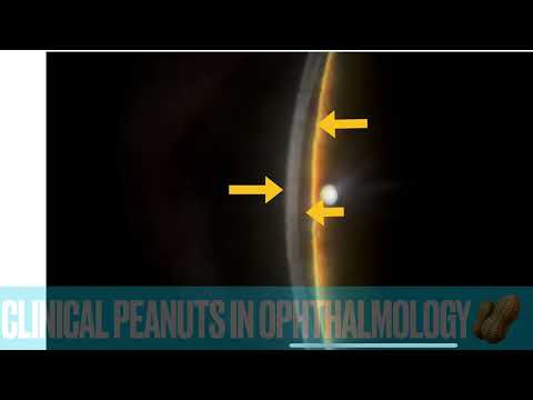 Van Herick & Peripheral Anterior Chamber Depth