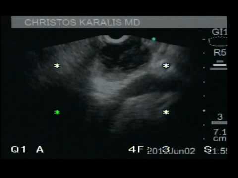 Solid pseudopapillärer Tumor des Pankreas