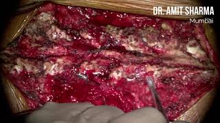 Free Hand Thoracic Pedicle Screw Insertion