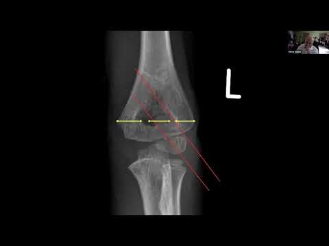 supracondylar fractures: treatment tips and tricks - Stephen Cooke