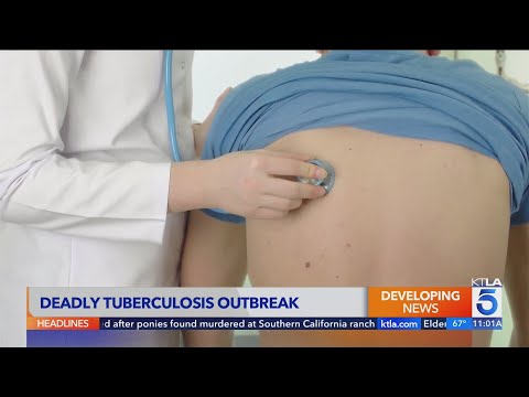 Long Beach declares public health emergency after deadly tuberculosis outbreak