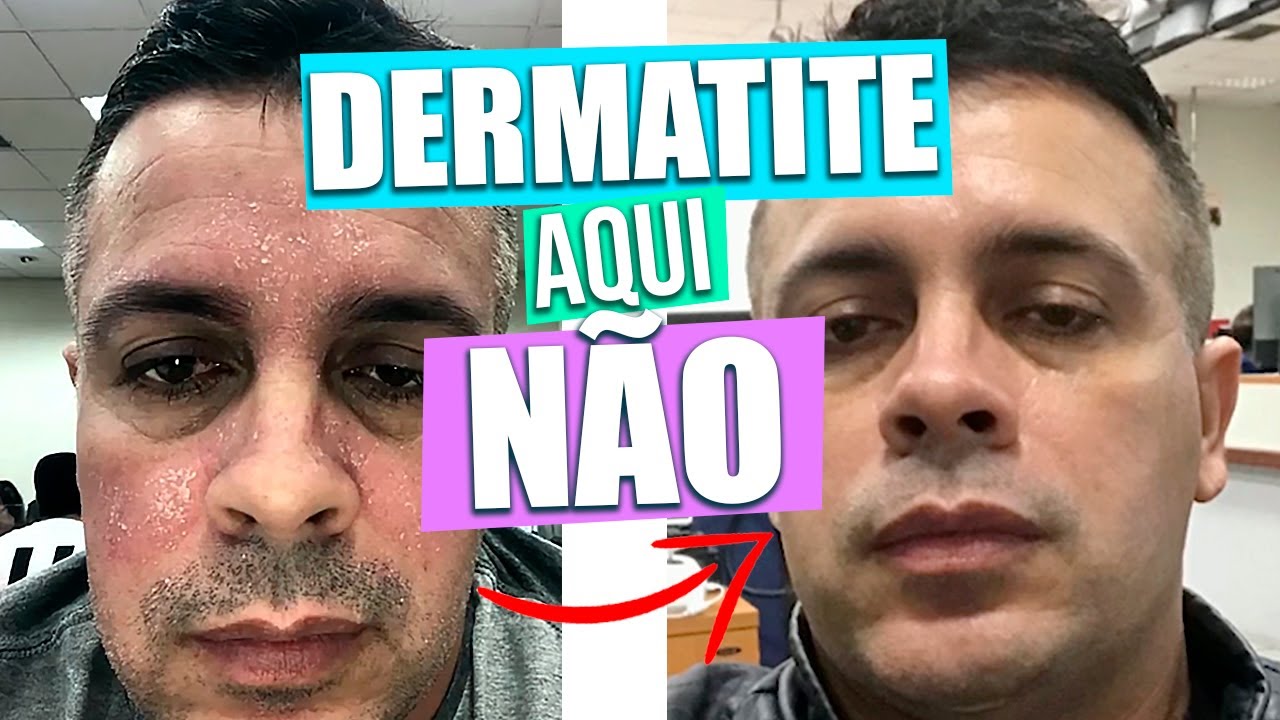 COMO CONTROLEI MINHA DERMATITE | PORQUE NINGUÉM FALA SOBRE ISSO