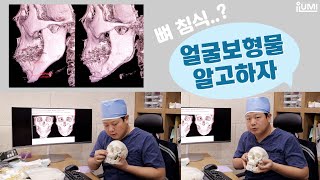 #얼굴보형물 ♦ 효과부터 부작용까지 : 아이루미성형외과