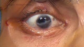 Ectropion Correction with Full Thickness Skin Graft