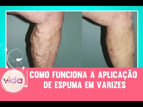 varicoza la sugage