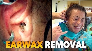 MASSIVE EARWAX REMOVAL! | Dr. Paul (feat. Maiya "My Wife")