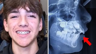 Excessive OVERBITE Correction....SAFE Orthodontic Options