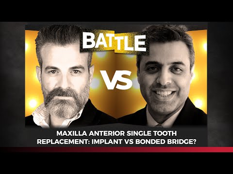 Maxilla anterior single tooth replacement: implant vs bonded bridge? with A. Ioannidis & S. Shahdad