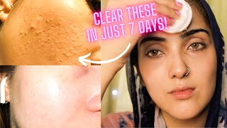HOW TO REMOVE TINY BUMPS ON FOREHEAD! Fungal Acne Remedy~ Immy