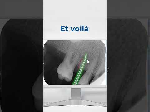 Diagnostic d'un abcès dentaire – Parodontologie