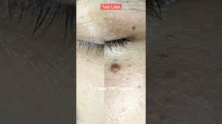 Download lagu Laser CO2 Tahi Lalat dan Skin Tags, Bisa Bedakan Keduanya? #laserco2 #Shineryaesthetic #beforeafter mp3 Download lagu Laser CO2 Tahi Lalat dan Skin Tags, Bisa Bedakan Keduanya? #laserco2 #Shineryaesthetic #beforeafter mp3