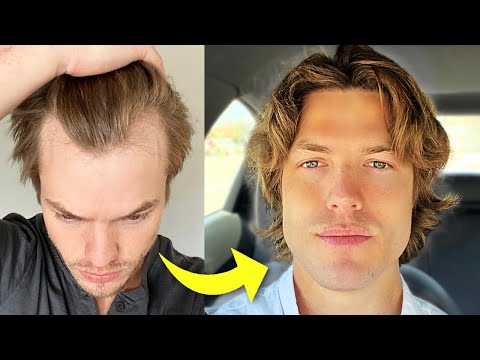 My Turkey Hair Transplant Results After 1 Year |...