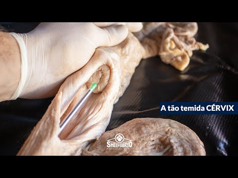 Como encontrar a entrada da cérvix no momento da inseminação