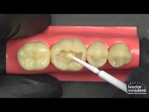 Tetric N-Bond : Adhésif Photopolymérisable - IVOCLAR VIVADENT
