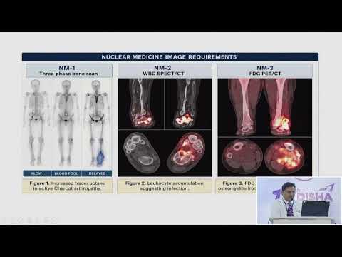 Charcot Neuroarthropathy | Dr. Vijay K Rao