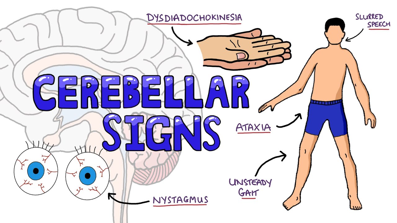 Cerebellar Dysfunction Signs Mnemonic - DANISH: What are the Signs of Cerebellar Dysfunction?