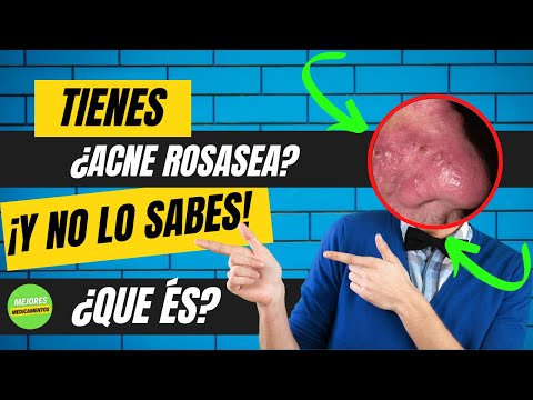 FIN A LOS PROBLEMAS DE LA PIEL - ACNE ROSASEA