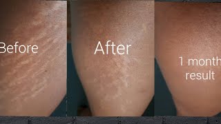 How To Reduce Stretch Marks/ DIY Amazing Home Remedies #stretchmarks #PermanentScarsRemoval