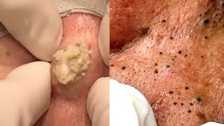 Cyst of the Year, Greatest Blackheads &amp; Comedones!