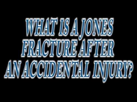 JONES FRACTURE (FIFTH METATARSAL) AFTER AN ACCIDENT?