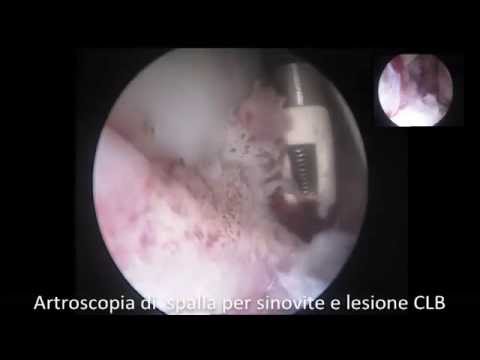 Trattamento di circuito di diclofenac osteoartrite Osteocondrosi del collo non può girare