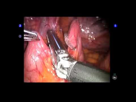 Robotic Ileovesicostomy for Neurogenic Bladder