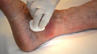 preview picture of video 'Ulss 1 Belluno - Dermatologia: come medicare una lesione ulcerativa'