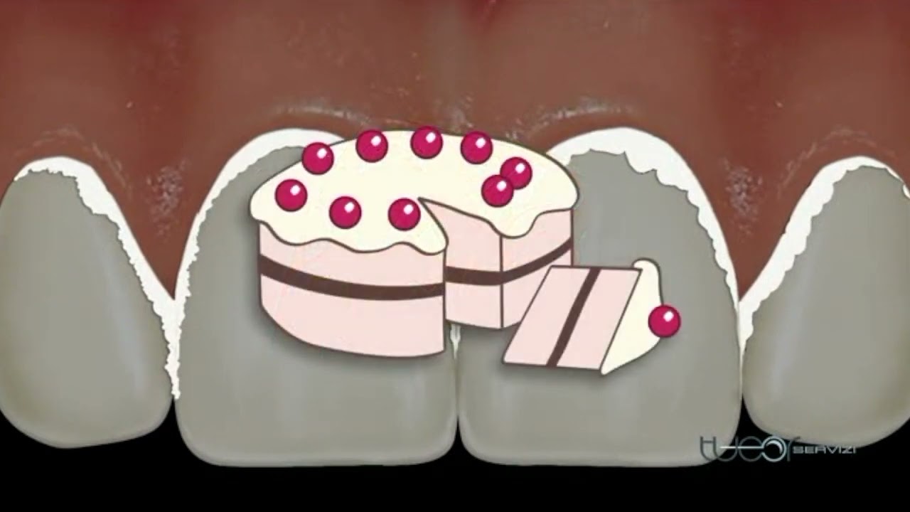 Ma cos'é la placca batterica?