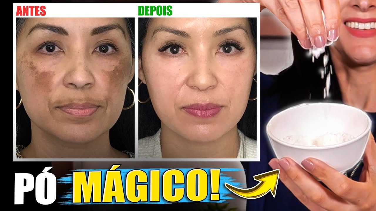 Use esse PÓ para Clarear Manchas de Pele, inclusive Melasma