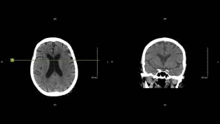 Unremarkable Non-Contrast Head CT Coronal Scan - Example 1
