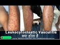 Leukocytoclastic Vasculitis / sudden red rashes / red spot on leg/ palpable purpura/ Dr Uttam Lenka