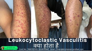 Leukocytoclastic Vasculitis / sudden red rashes / red spot on leg/ palpable purpura/ Dr Uttam Lenka