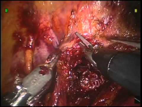 Prostatectomy - Present Technique